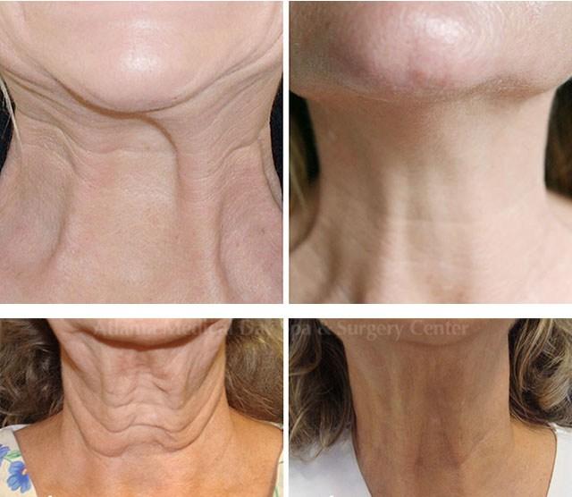 Ботулинотерапия шейной области результаты